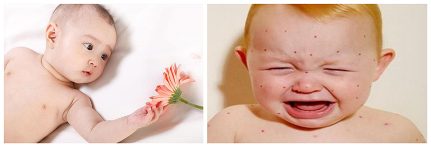 兒童濕疹反反複複，您有在家安裝家用除濕產品嗎？